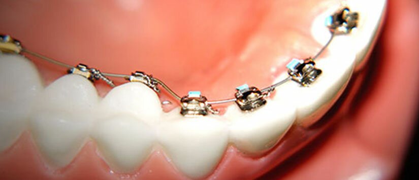 Görünmeyen Diş Teli